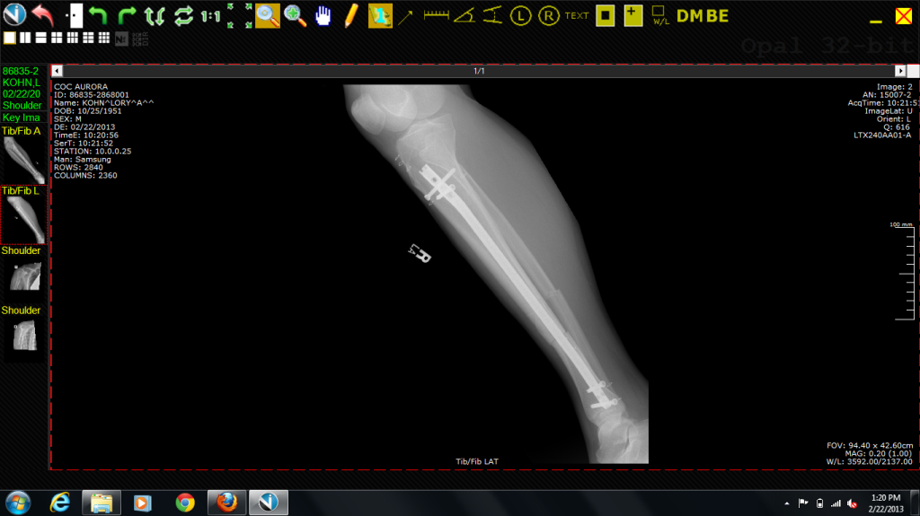 Lory's repaired tib fib compound fracture.